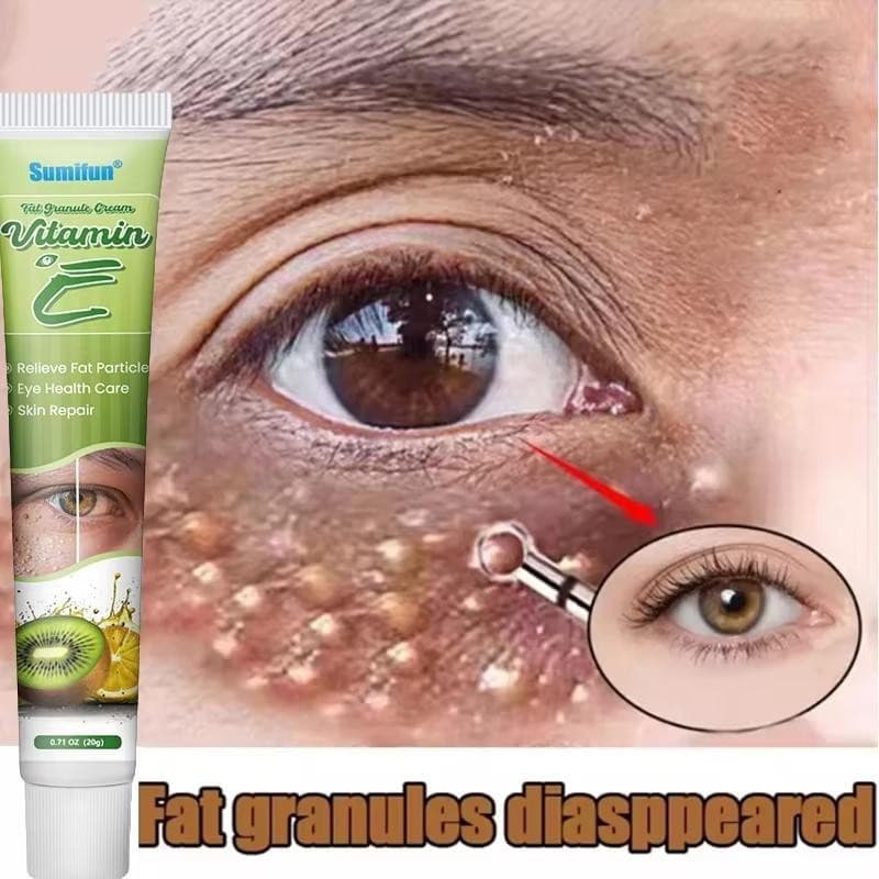 Creme para os Olhos para Remover Grânulos de Gordura, Elimina Eficazmente o Inchaço, Anti-Milia, Produto de Cuidado e Re