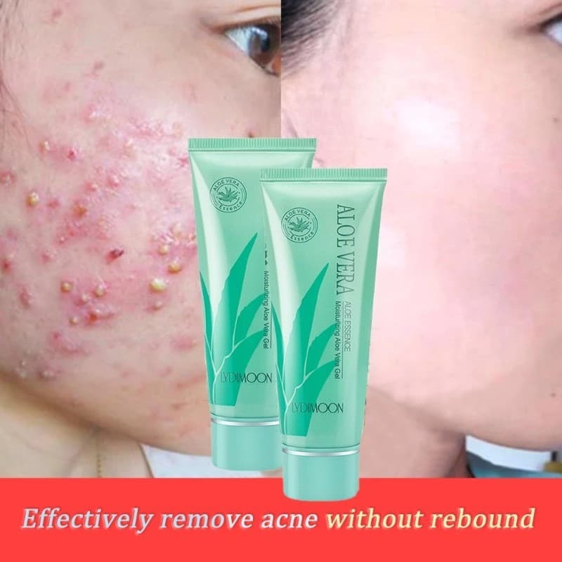 gel Removedor De Acne 40g , Hidratante E Retrátil De Poros , Controle De Óleo , Remoção De Manchas , Clareamento Da Pele