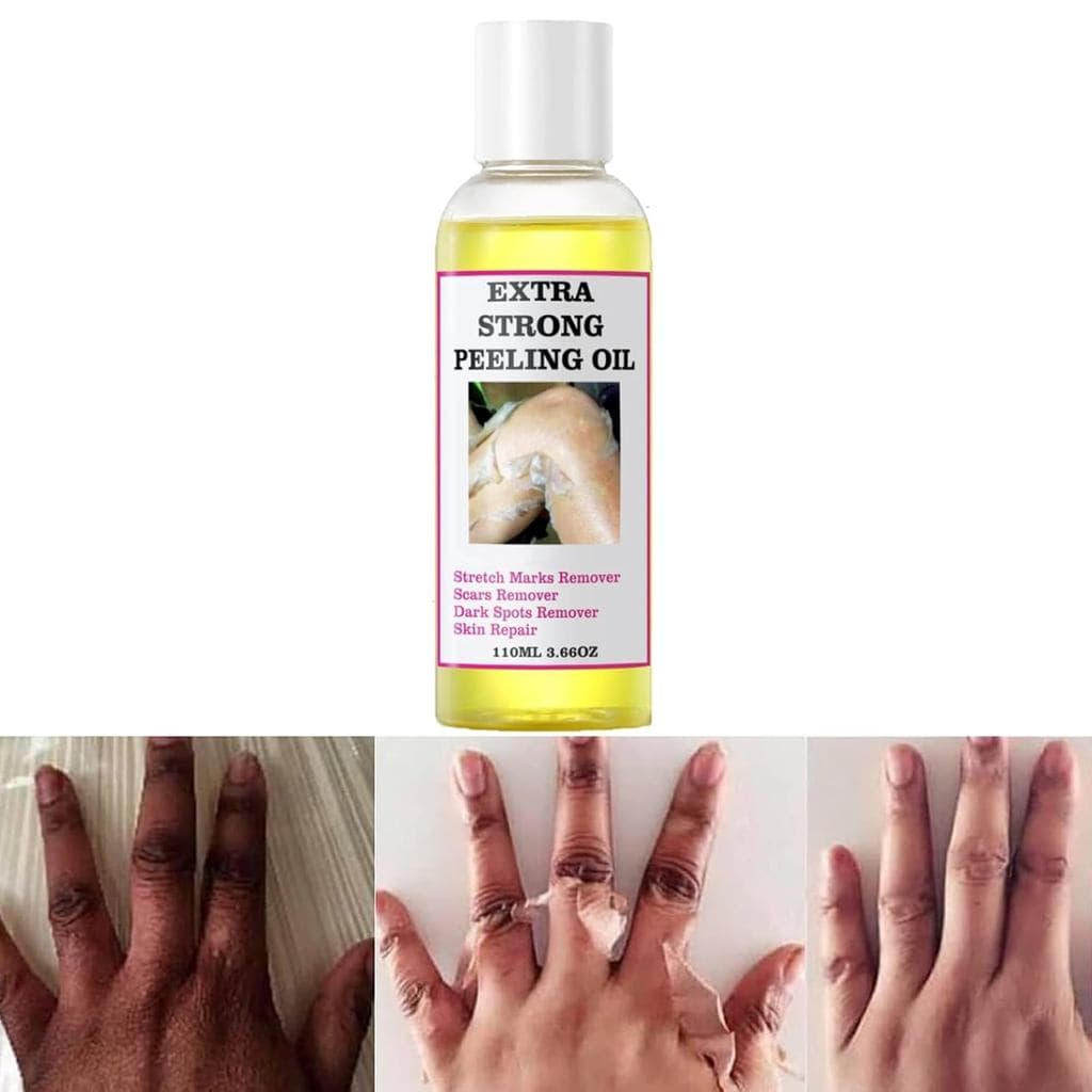 Óleo Esfoliante Amarelo Extra Forte Genérico para Pele Escura - Solução Esfoliante para Corpo, Mãos, Pés e Rosto - Todos