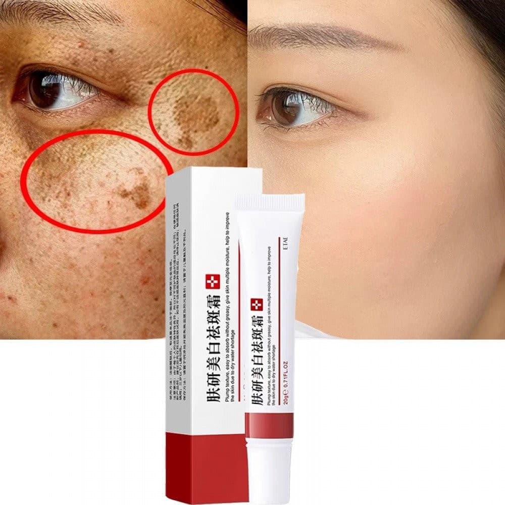 Creme Clareador e Removedor de Manchas Escuras, Usado para Remover Melasma, Clarear a Pele UJPX