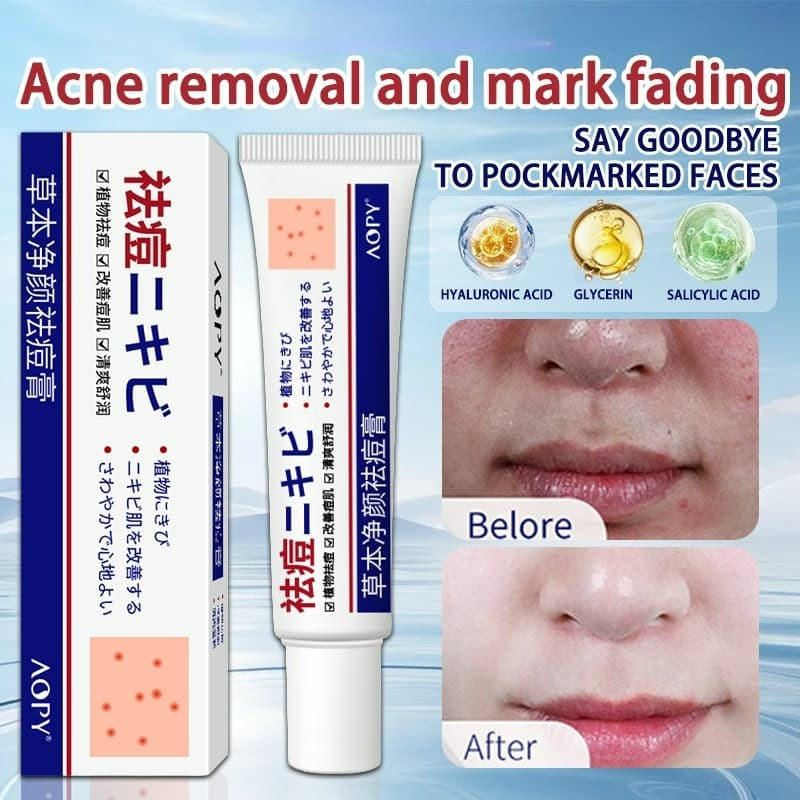 Creme De Ervas Para Remoção De Cicatrizes De Acne , Comedões Fechados Facial , Jovem , Hidratante Suave , Manchas Claras