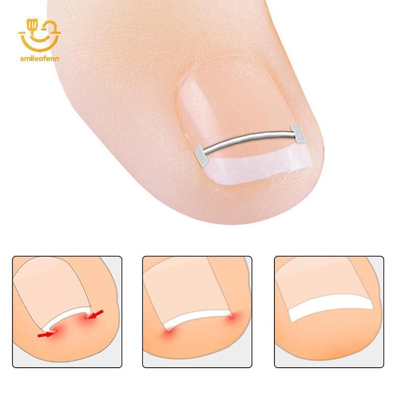 smileofenn Ferramentas Corretoras De Unhas Encravadas Pedicure Recuperar Incorporar Tratamento De Dedo Do Pé Profissiona