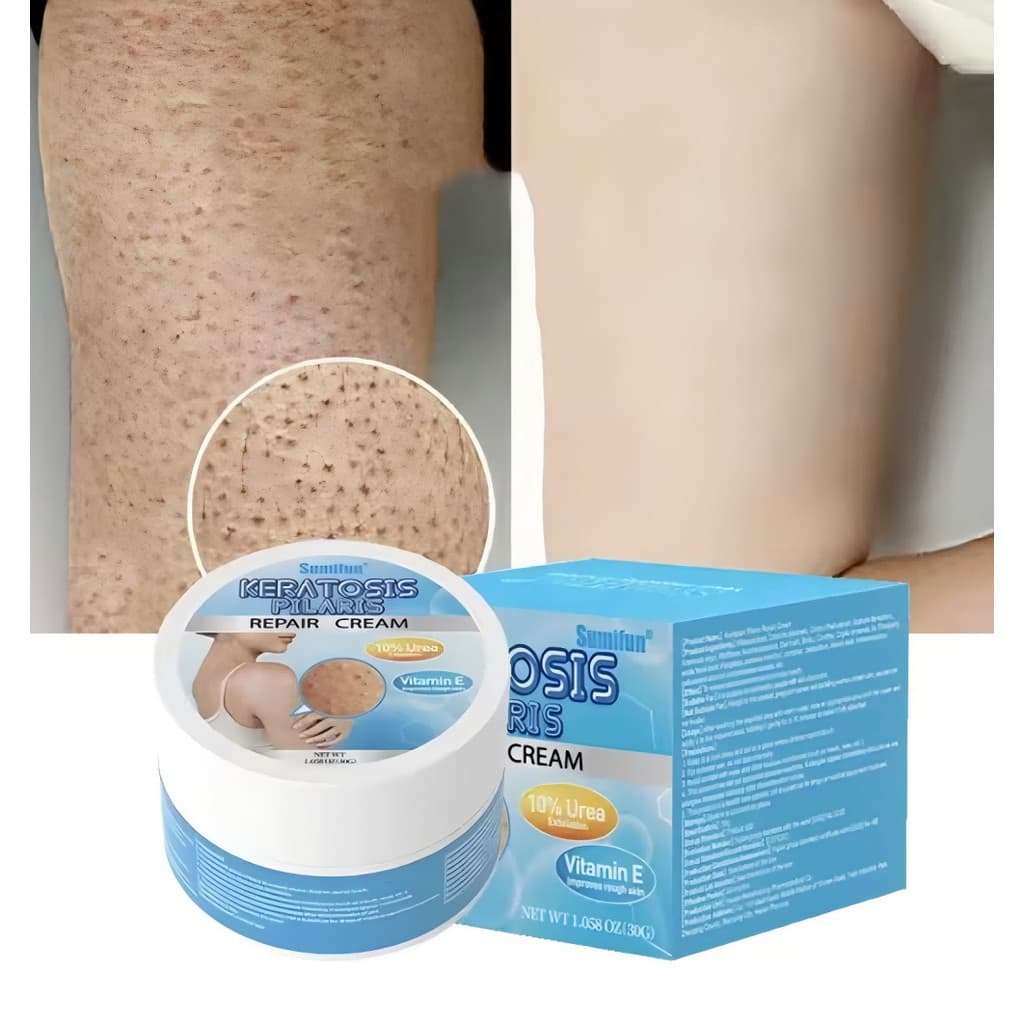 Keratose Pilaris Repair Treatment Creme Esfoliante Remoção De Pele De Frango Acne Spot Limpeza Hidratante Suave