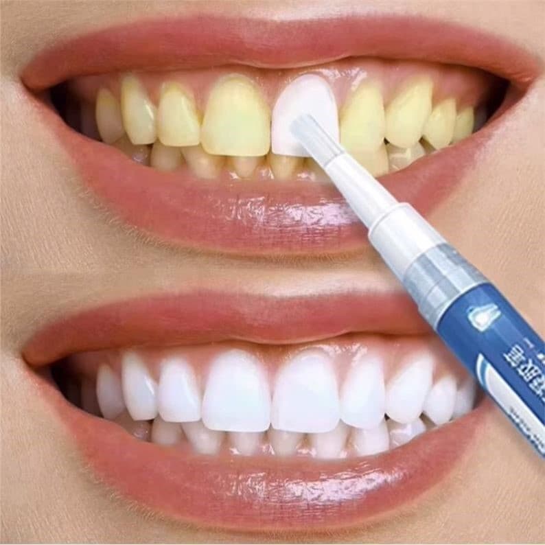 Hot ~ Removedor de manchas nos dentes com uma fricção ~ Manchas de tabaco pretas ~ Manchas de chá ~ Remover manchas de c