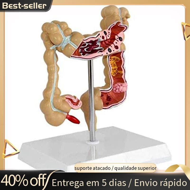 Modelo Corretal Patológica Colon De Intestino Grande Anatômico Gastrointestinal