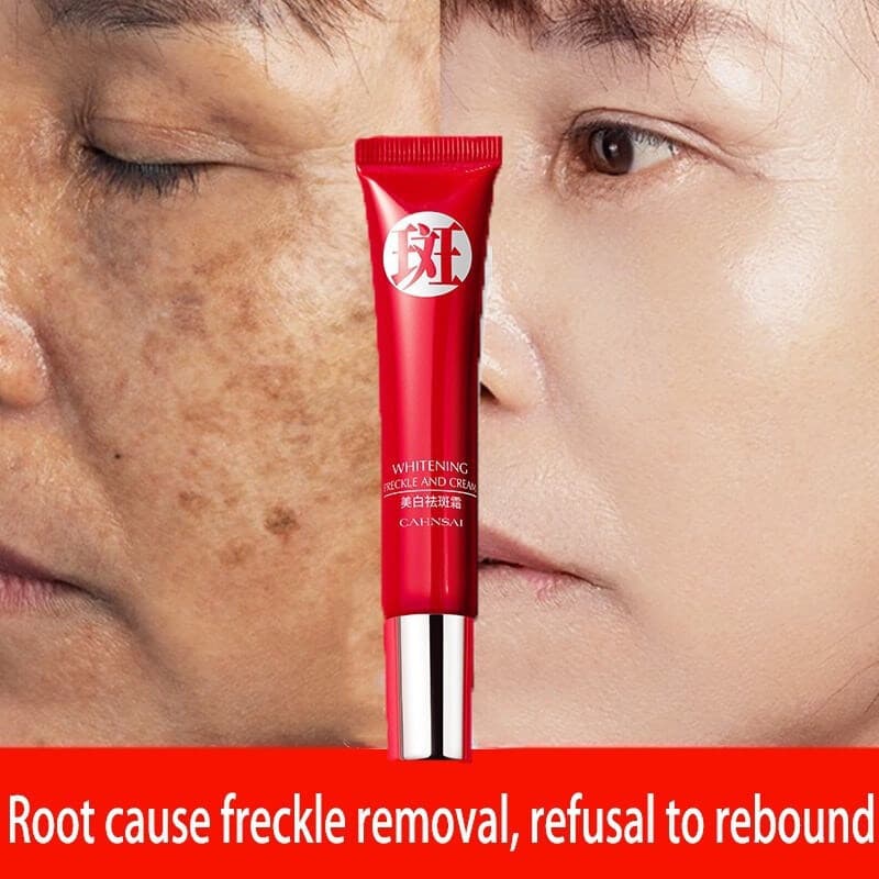 Creme Original Poderoso para Remoção de Sardas/Redução de Manchas Escuras/Cuidado para Clareamento da Pele