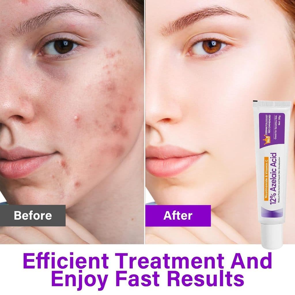 Pomada de Niacinamida para Redução de Cicatrizes de Acne e Remoção de Acne