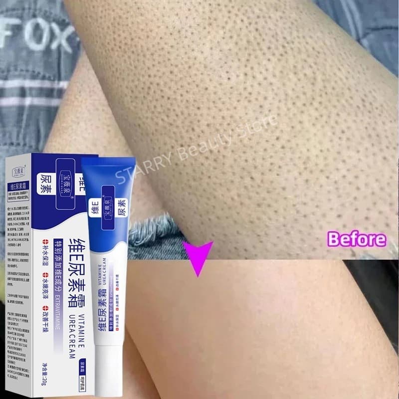 Keratose Pilaris Tratamento Creme De Folículo De Frango Reparação Da Pele Corpo Removedor De Manchas Escuras Clareamento