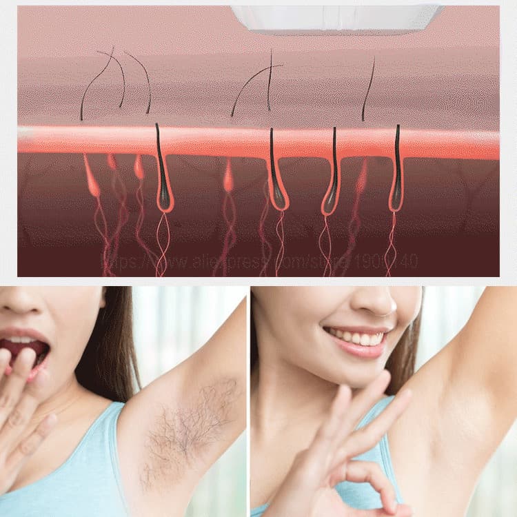 【Uso Doméstico】Aparelho de Depilação a Laser Indolor/Depilador a Laser/Para Mulheres