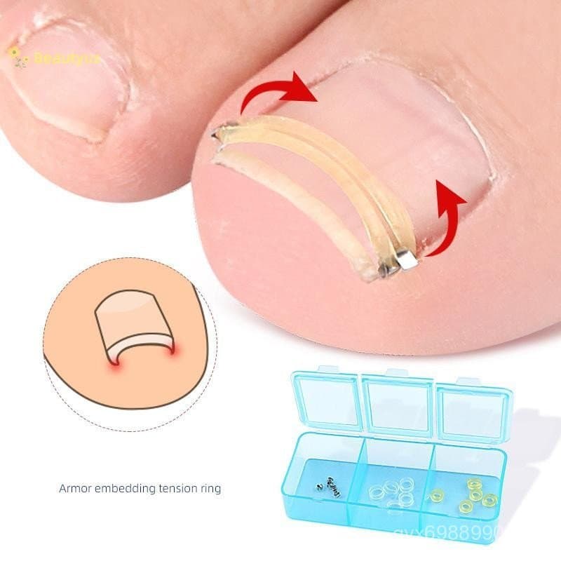 Corretor de Unha Encravada Beautyus, Pedicure, Recuperação, Tratamento, Correção dos Pés, Adesivos, Ferramenta