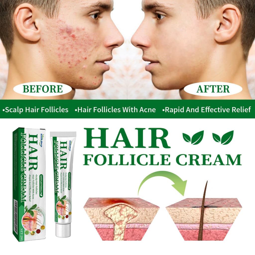 20g De Creme Para Cuidados Com A Pele Folículos Capilares Nas Costas , Rosto E Cabeça – O Tratamento De acne , Alívio De