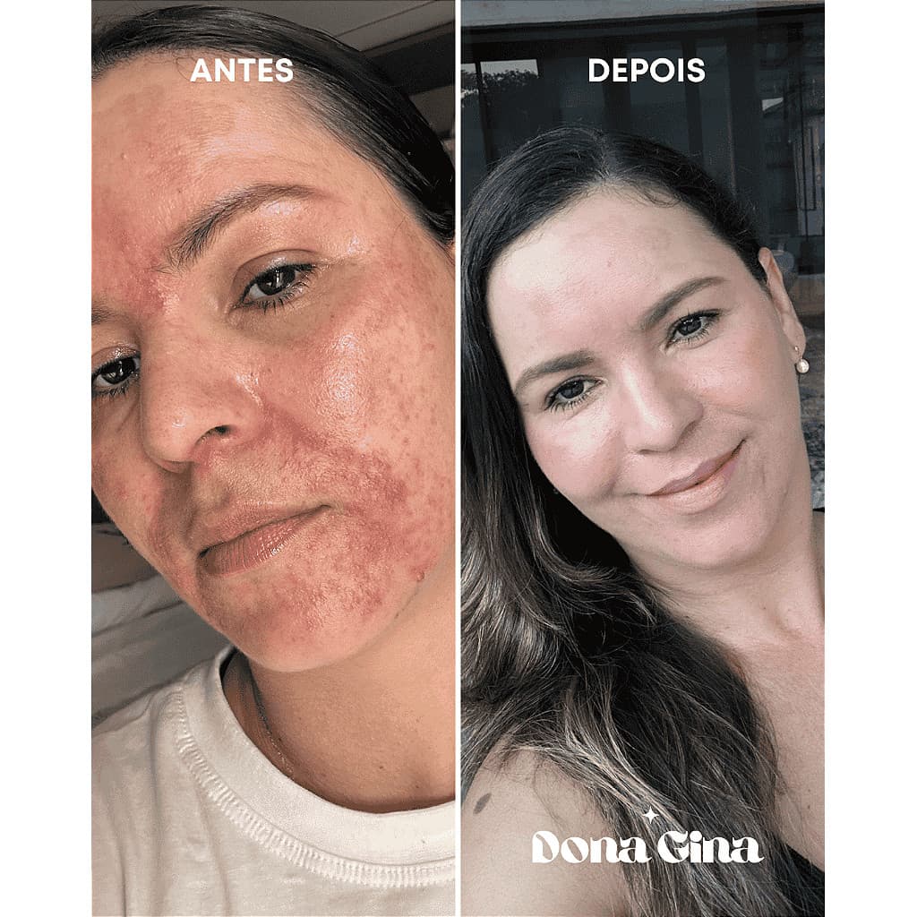 SABONETE PELE SENSÍVEl (DERMATITE E PSORÍASE) | DONA GINA 60g