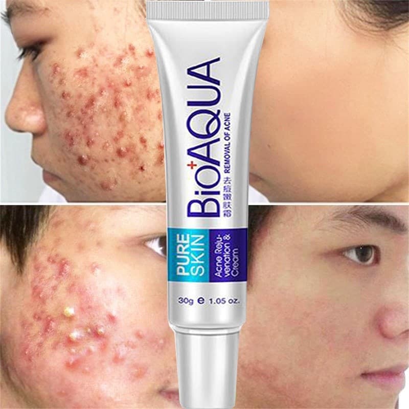 Creme Para Remoção De Cicatrizes De Bolhas/Tratamento Anti-Acne/Clareamento/Controle De Óleo/Poros Escuros