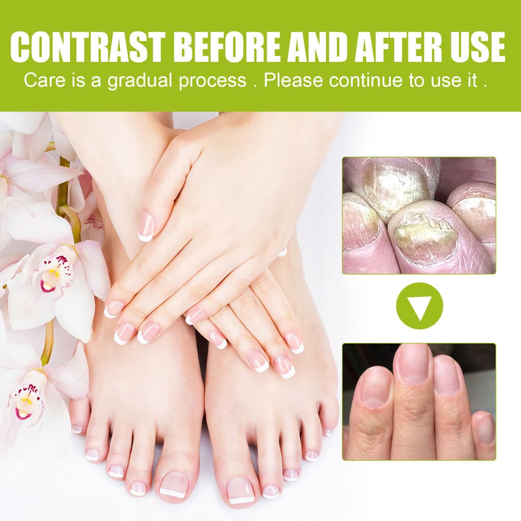 EELHOE Gel Antifúngico Original Para Reparo De Unhas Fungos