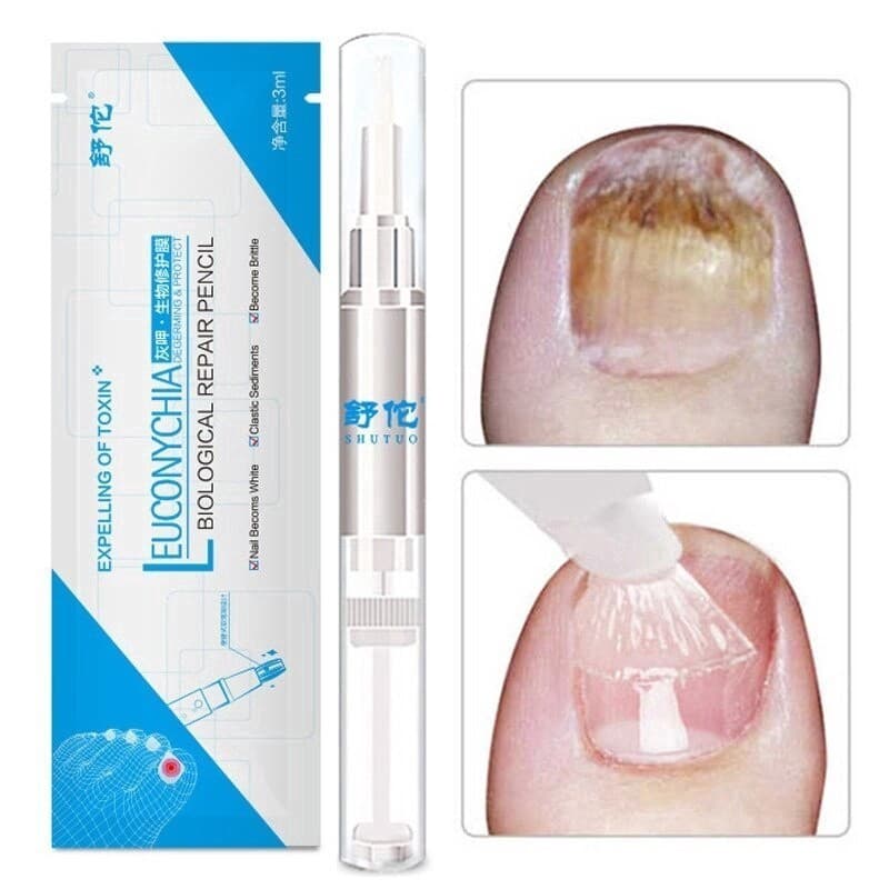 Caneta Para Unhas , Doença Fúngica De Onicomicose , Infecção À Base De Ervas , Dedos Dos Pés , Saúde