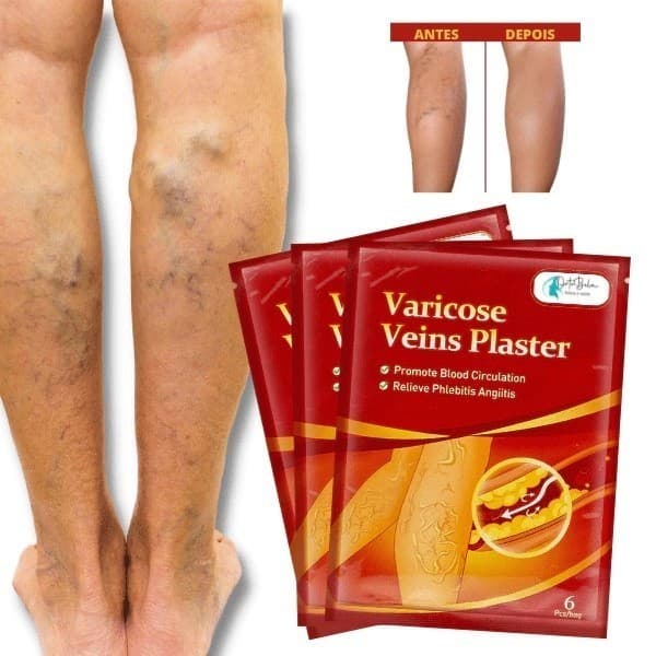 Adesivos para Varizes Auxilia Diminuição Vasos E Veias