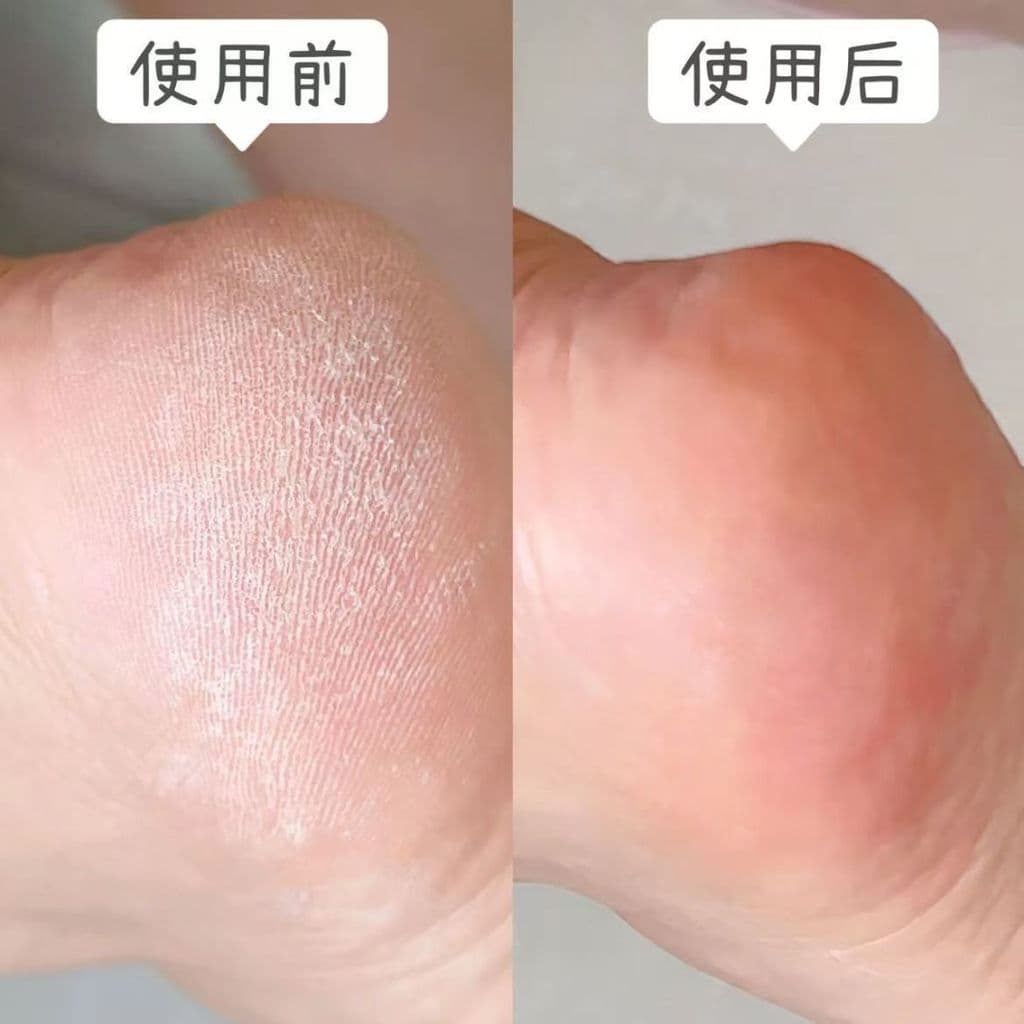 Dedicado pé peeling solas sério peeling calos áspero pele dura esfoliante pele morta poderosa máscara de pé seco calcanh