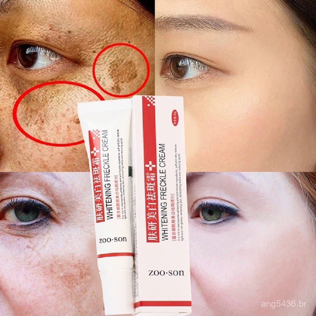 Creme para Sardas Remove Melasma da Pele Acne Pigmento Melanina Manchas Escuras Clareamento Rápido