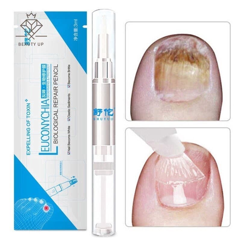 Caneta Para Unhas Onicomicose Parony Infecção Herbal Toe Health Nails