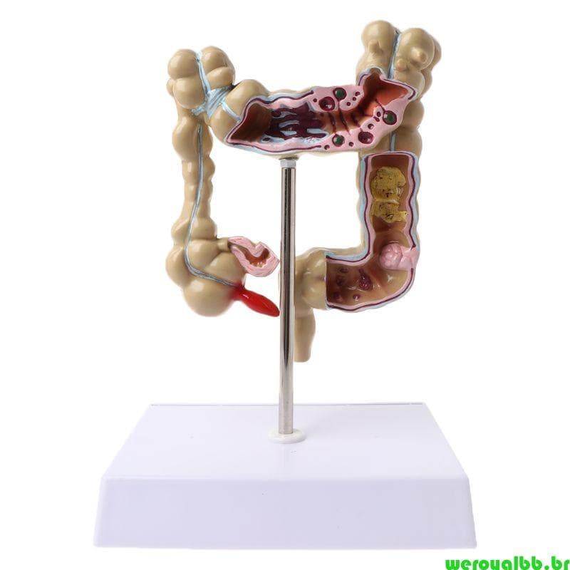 weroyalbb Modelo Lesão Colorectal Humana Anatomia Patológica Doenças Cólon Intestino