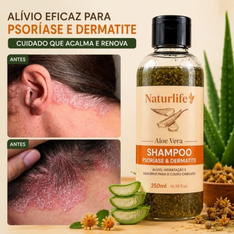 Shampoo Poderoso Psoriase,dermatite 250ml | SEM SAL
