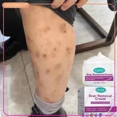Creme Corporal Renovador | Suaviza a Aparência de Marcas Antigas, Cicatrizes, Manchas e Imperfeições da Pele