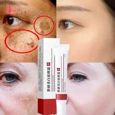 Creme Branqueador Para Remover Melasma Manchas Escuras , Melanina , Pele Brilhante