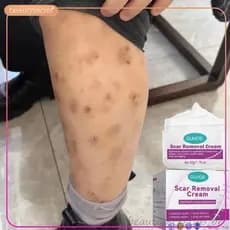 Creme elimina cicatrizes pretas remover feridas antigas mosquitos mordidas espinhas queimar escalas beleza