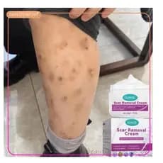 Creme Para Cicatrizes Pretas Remove Feridas De Picadas De Insetos Antigas De Queimaduras Quelóides-Beleza