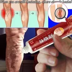Avaliação das varizes para o tratamento da flebite das pernas das minhocas