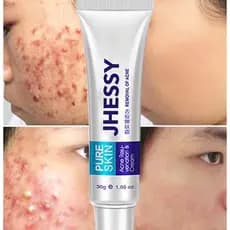 Creme De Remoção De Borbulhas Para Tratamento De Cicatrizes/Anti-Acne/Branqueamento/Controle De Oiliness/Poros Escuros