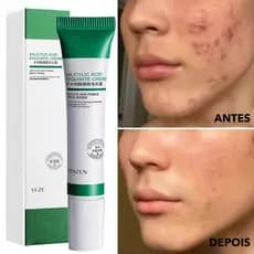 Creme De Ácido Salcyclic 20ml Para Remoção De Poros/Acne & Clareamento/Anti-Ássidade 20ml