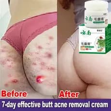Creme De Remoção De Acne Corporal Tratamento Rosto Bunda Costas Marcas Reparação Suave Pele De Frango Hidratante Claream