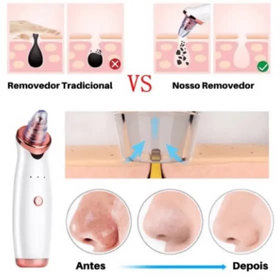 Removedor de Cravos a Vácuo Recarregável – Aparelho de Limpeza Facial Profunda