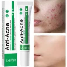 3 Unidades De Creme De Tratamento De Acne Com Ácido Salicílico Para Reparar Manchas , Limpar Profundamente Os Poros E Re