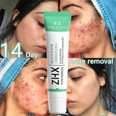 Creme para tratamento de acne, creme para tratamento de cicatrizes, gel para tratamento de acne, tratamento localizado p