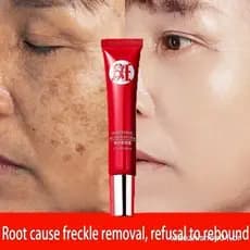 Creme forte original para remover manchas escuras/clareamento pigmentado/cuidados com a pele QRJZ