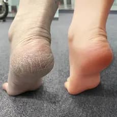 Xiaohongshu 15 segundos suavizante esfoliante amaciante calos de pele antiga máscara para pés faca de Pedicure seco calc