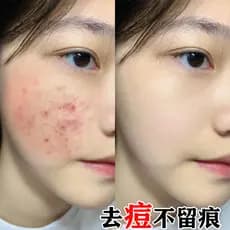Compre 2 e ganhe 1 grátis [remover o rosto 99% coisas sujas] Limpeza facial de poros Remoção de ácaros faciais Sabonete