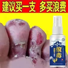 Lobo venenoso pé Spray pé ar dedicado anti-coceira creme infecção de fungo Peeling de água pé ruim pequena bolha esteril