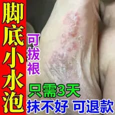 Pequenas bolhas no pé solas do pé coceira e peeling cura pé coceira peeling pé mau pé pé Anti-coceira cura estéril