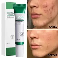 Creme de Ácido Ciclólico 20ml Para Remoção de Poros/Clareamento de Acne/Anti-Acidez 20ml VENZEN ZHVF