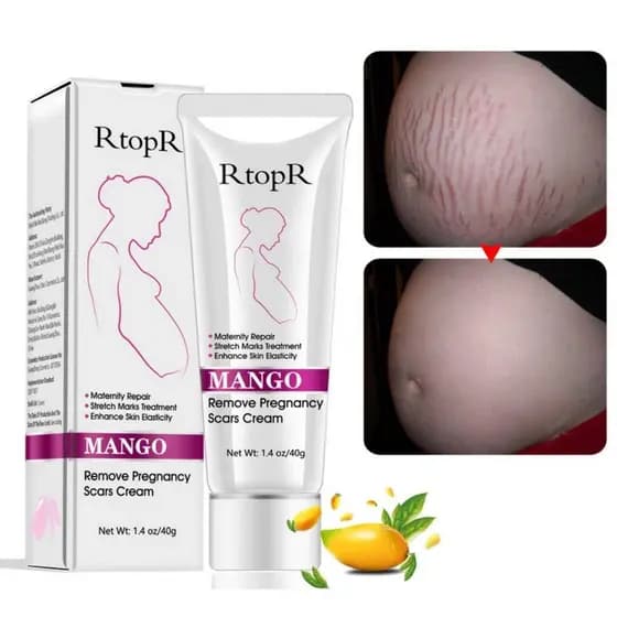 Creme para Estrias e Cicatrizes de Manga, Creme para Remoção de Estrias e Cicatrizes de Gravidez, Creme para Rugas na Ba