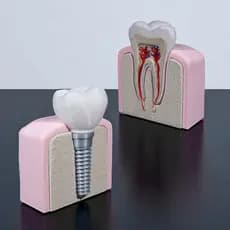 Modelo Anatômico Dente Molar ou Implante Estudo Anatômico Boca Dente. Decoração, presente, dentista