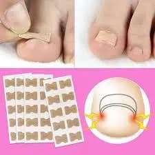 Kit 30 Adesivos Órtose Correção de Unhas Encravadas Manicure Pedicure Adesivo Unha