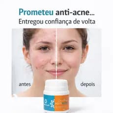 Creme ANTI ACNE 50g seca rápido fim das espinhas cravos e inflamações
