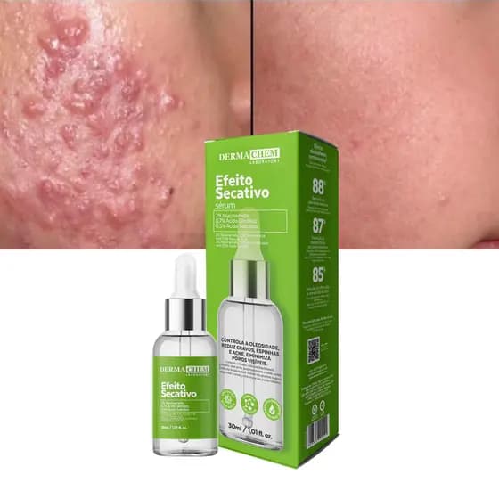 Sérum Facial Efeito Secativo Controle de Acne, Oleosidade, Cravos e Espinhas 30ml | Dermachem