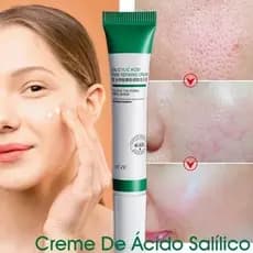Creme Ácido Salicílico Anti Acne Espinhas Cravos Controle Da Oleosidade