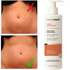 Creme Anti-Estrias - Diga Adeus às Estrias! Previne Novas Estrias & Reforça a Elasticidade Da Pele