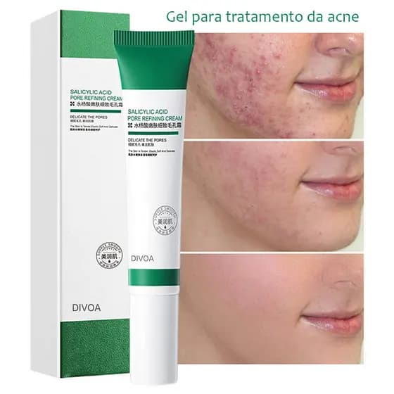 Creme De Ácido Salcyclic 20ml Para Remoção De Poros/Acne & Clareamento/Anti-Ássidade